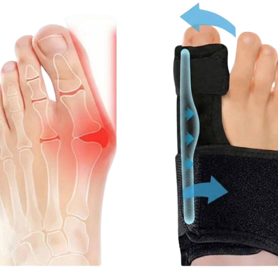 Trevif+ Vaivaisenluun Oikaisija – Helpotusta ilman leikkausta